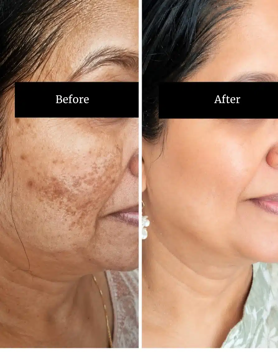 Before and After Treatment
